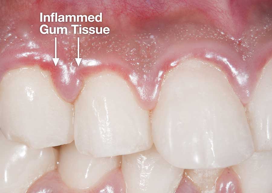 Gum inflammation.